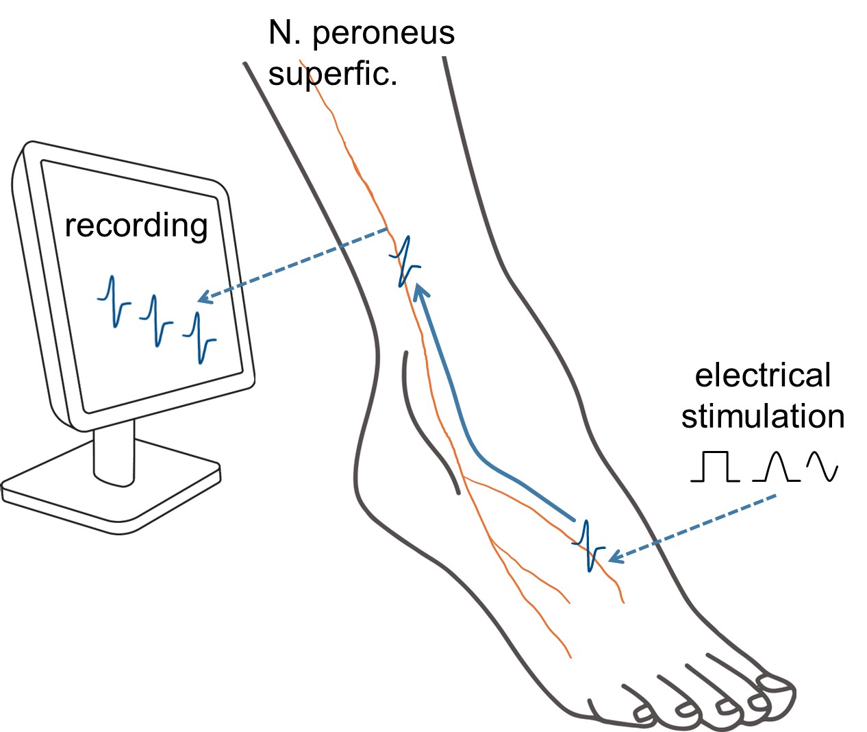 Diagramm eines Fußes mit hervorgehobenem Nervus peroneus superficialis. Eine elektrische Stimulation wird auf den Nerv angewendet, während die Reaktion auf einem Monitor aufgezeichnet wird. Beschriftungen im Bild beinhalten „N. peroneus superficialis“, „recording“ und „electrical stimulation“.