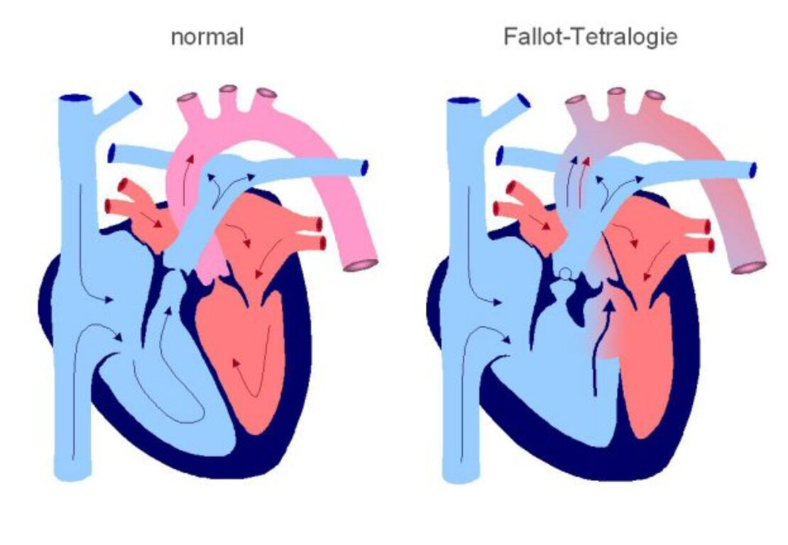 Fallot Tetralogie